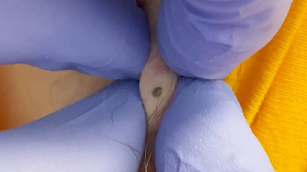 Simple Blackhead Extraction 2 Simple Blackhead Extraction 1