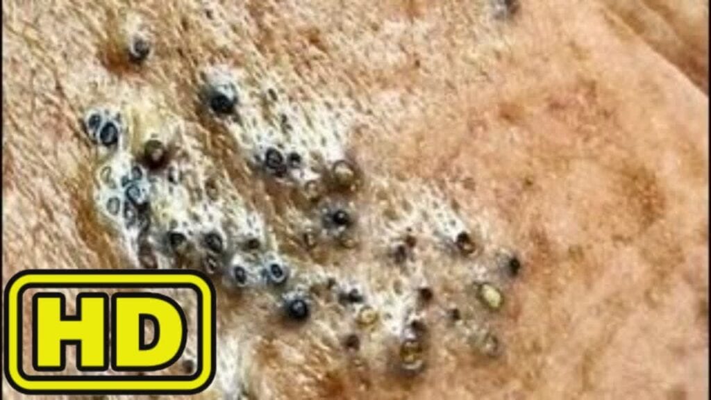 Simple Pimples 1