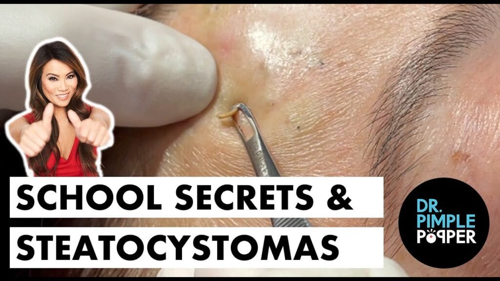 Steatocystomas 2 Steatocystomas 1