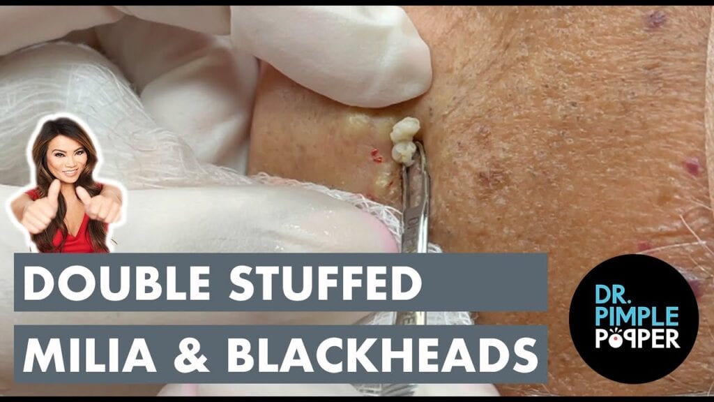 Double Stuff! Blackheads 1