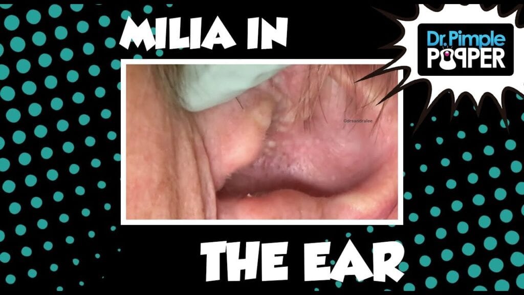 Ear Milia 1