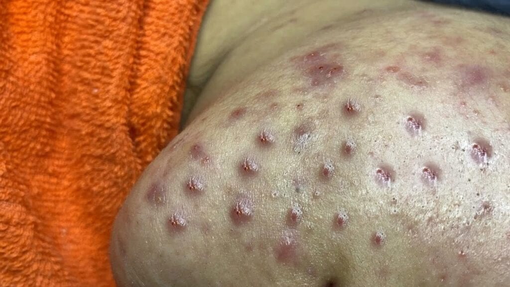 Poke and Squeeze Pimples 2 Poke and Squeeze Pimples 1