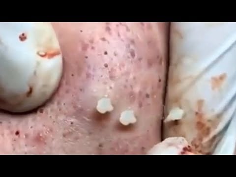 Squeezing Pimples and Blackheads 1