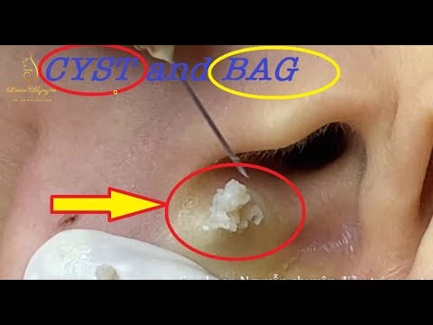 Triple Pimples 1