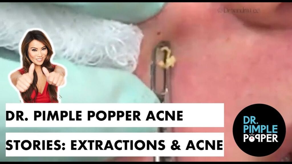 Acne Stories 1