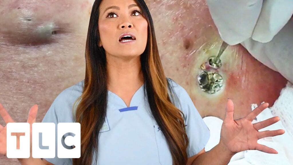 Biggest Blackhead Award 1