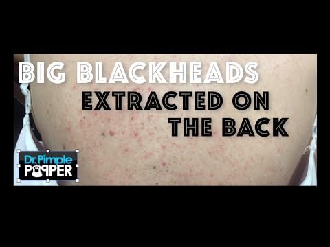 Classic Blackheads 2 Classic Blackheads 1