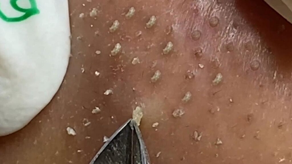 Cute little bumps - whiteheads and blackheads 1