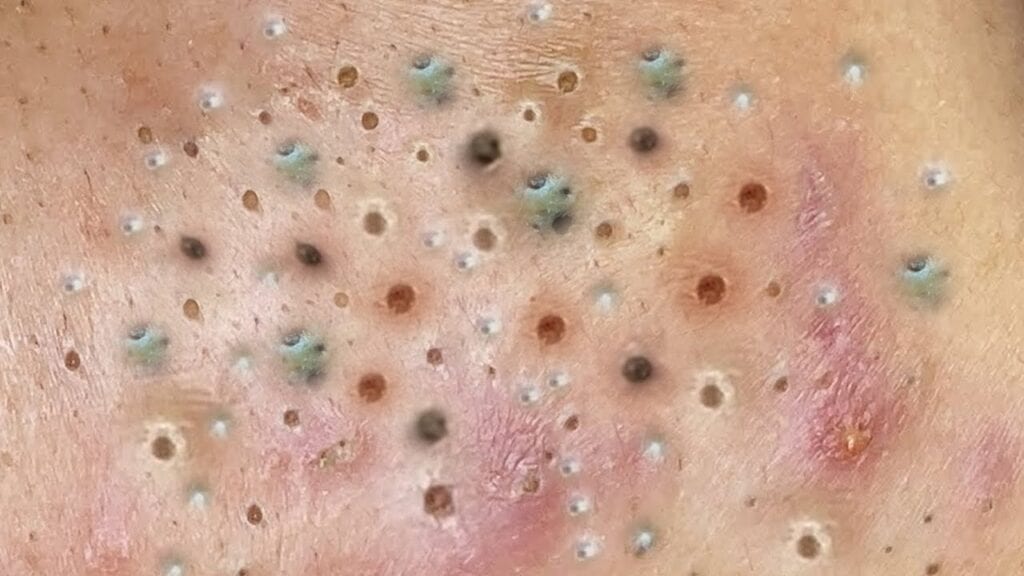Loan Nguyen Pimple Treatment 1