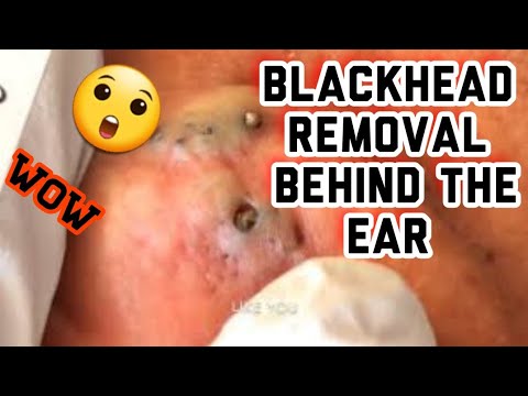 Never Ending Pimple Pop 2 Never Ending Pimple Pop 1