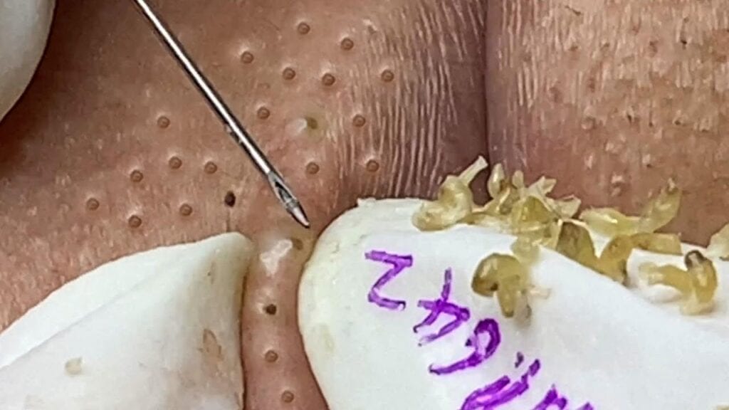 Severe Acne 1
