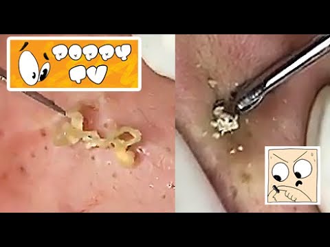 Whiteheads Extractions 1