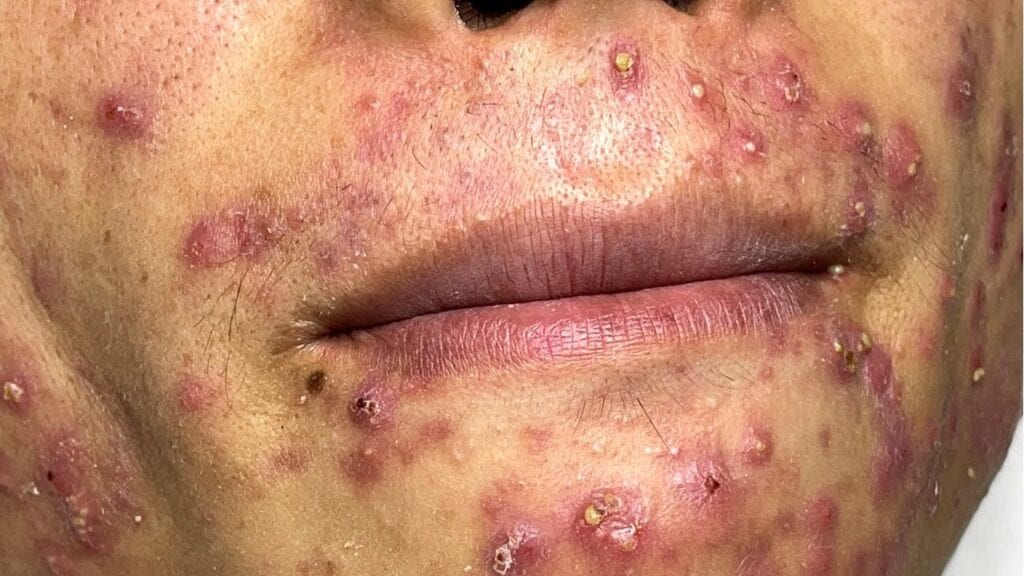 Acne Pimple Pops 1