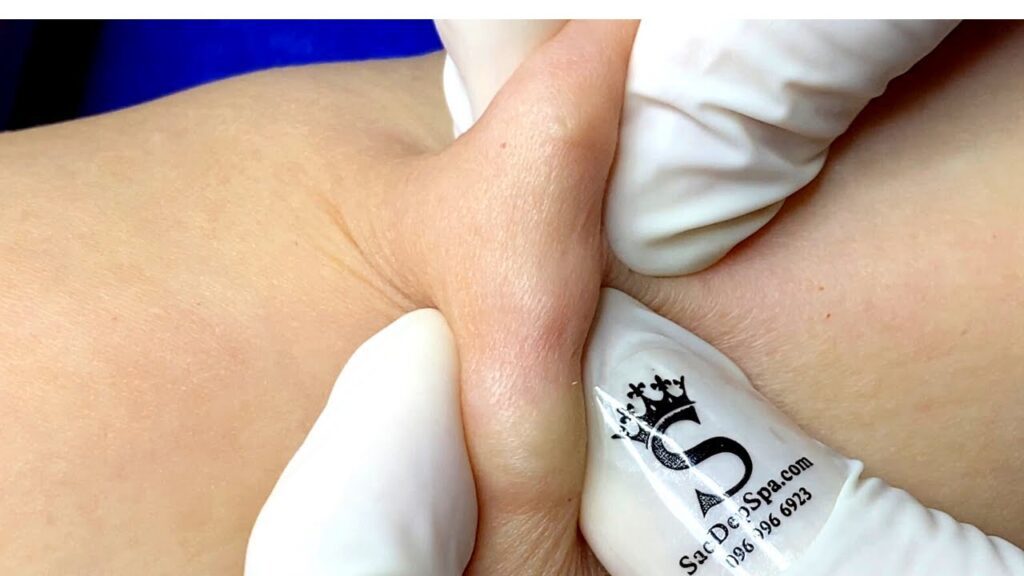 I’m not sure these are zits… 1