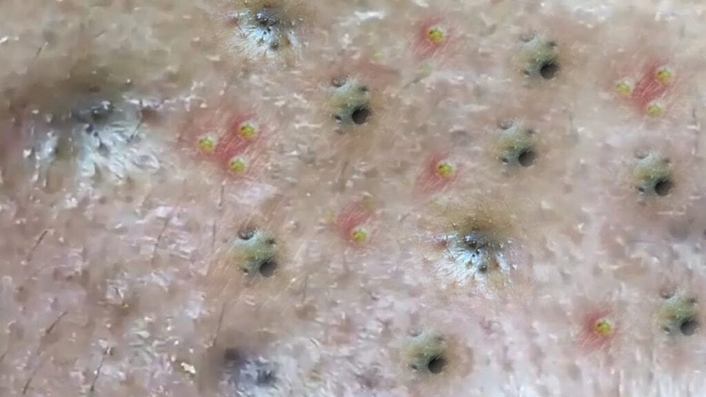 Loan Pokes Pimples 1
