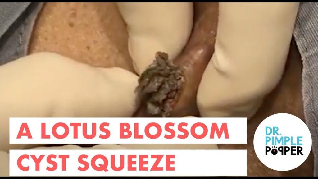 Lotus Flower Cyst 1