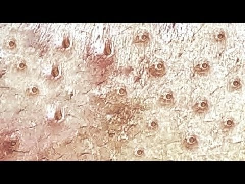 Pimple Trophy Glove 1