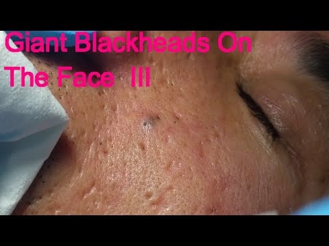 Severe Acne 1