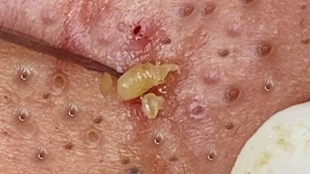 Superb Pimple Pops 2 Superb Pimple Pops 1