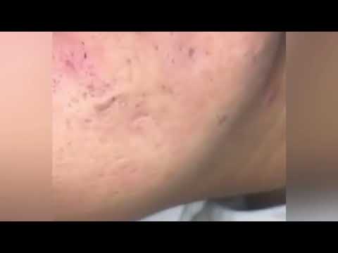 Unending Pimple Squeeze 2 Unending Pimple Squeeze 1