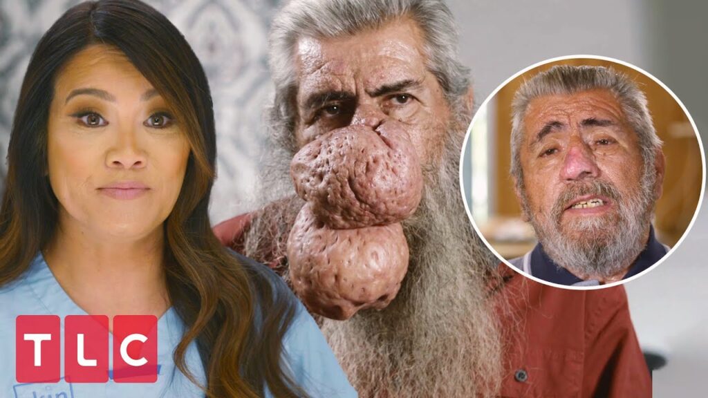 Amazing Rhinophyma Transformation 1