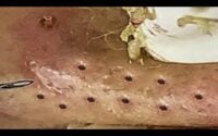 Loan Spa Pimple Popping 1 Loan Spa Pimple Popping 1
