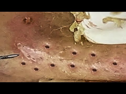 Loan Spa Pimple Popping 2 Loan Spa Pimple Popping 1