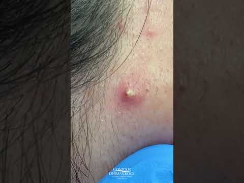 Short and Sweet Pimple Pop 2 Short and Sweet Pimple Pop 1