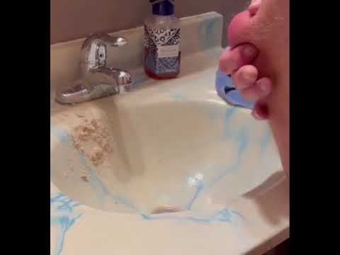 The Biggest Cyst Ever! 2 The Biggest Cyst Ever! 1