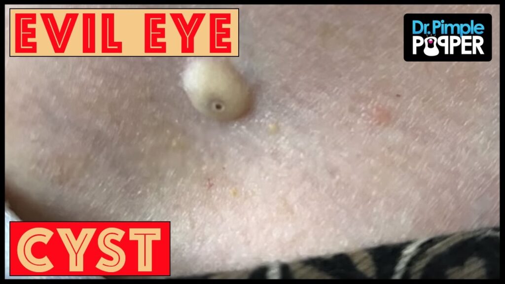 The Cyst with the Evil Eye 2 The Cyst with the Evil Eye 1