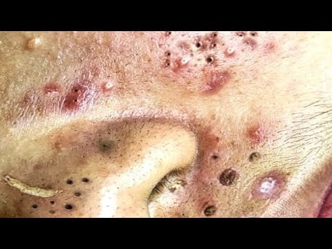 The Relaxing Pimple Pops 2 The Relaxing Pimple Pops 1