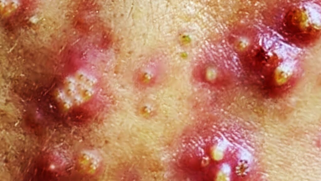 Whiteheads are Popping 1