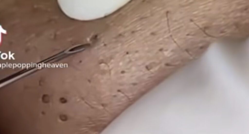 Sebaceous Material Around Jaw 1