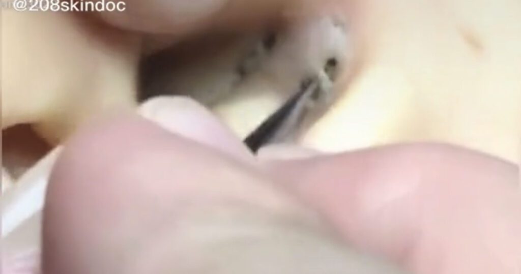 Never Ending Blackhead in Ear 1