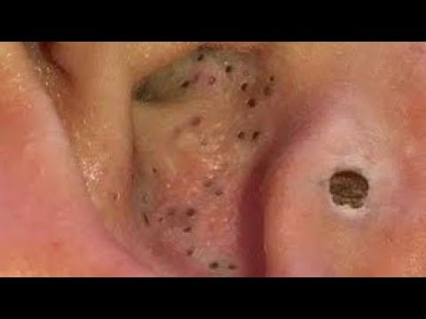 Blackhead Digging 1