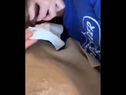 Gag-worthy Cyst 1