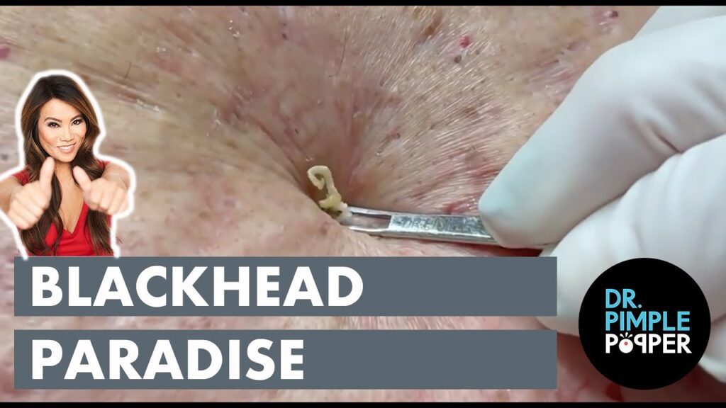 Paradise of Blackheads 2 Paradise of Blackheads 1