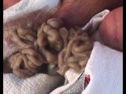 This Cyst Will Come Back 2 This Cyst Will Come Back 1