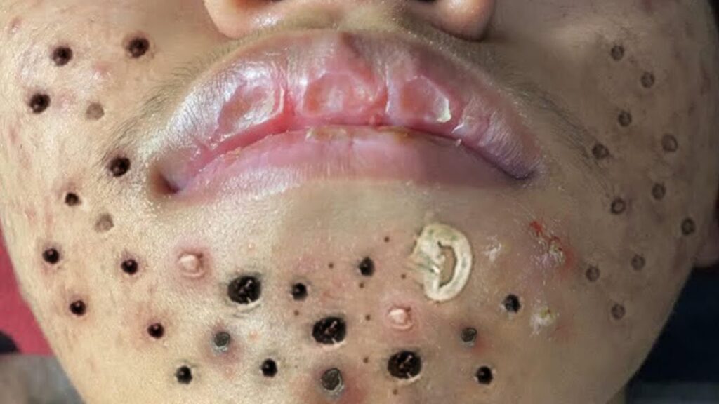 Zit Popping Relaxation 1
