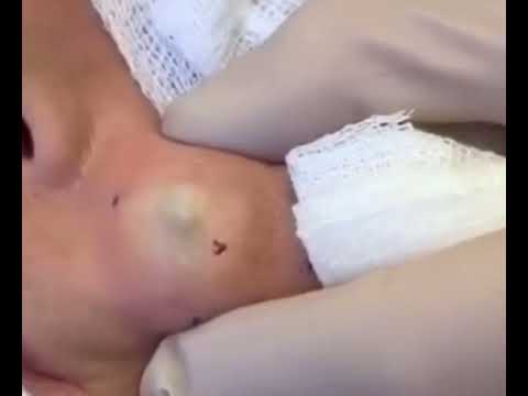 Cottage Cheese Cyst 1
