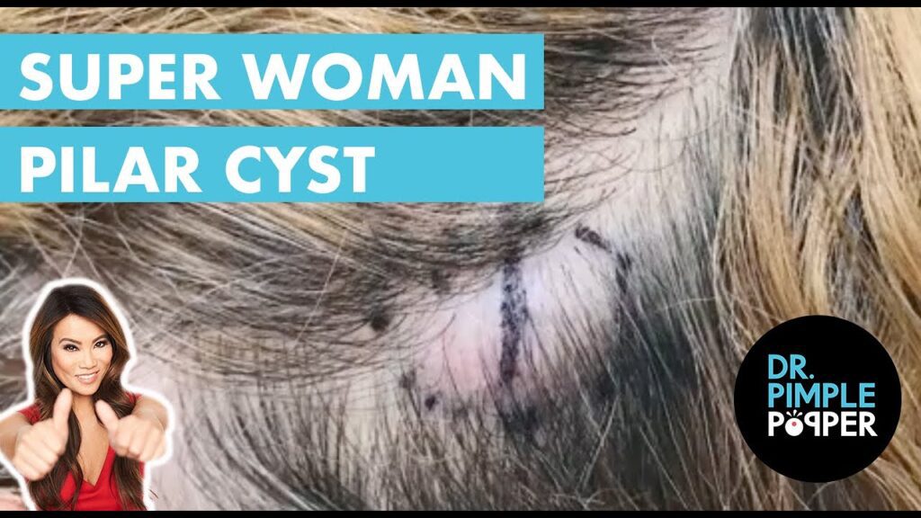 Superwoman’s Cyst 1