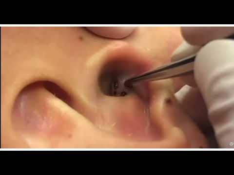 What on Earth? (Not a Pimple) 1