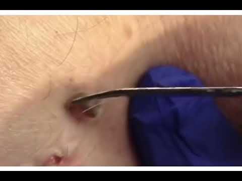 What Type of Zit? 1