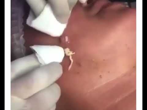 A Pimple Short 1