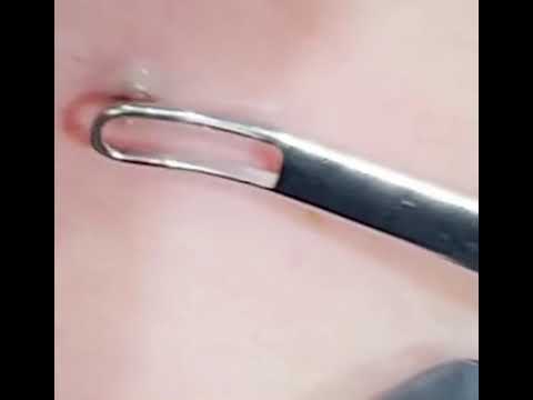 Blackhead Removal 2 Blackhead Removal 1