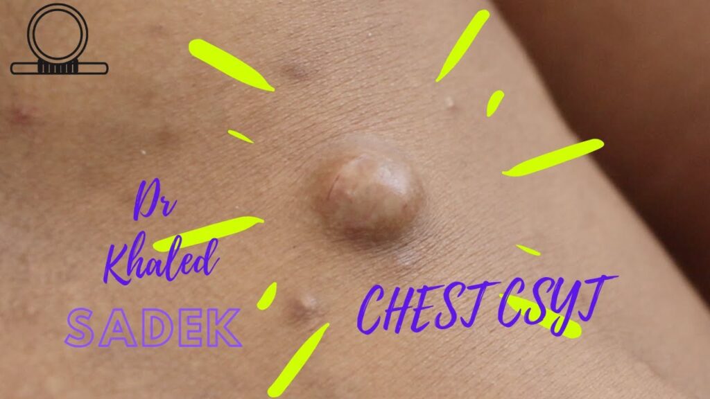 Cherry Cyst Removal 1