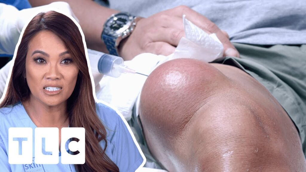 Chunky Cyst 1