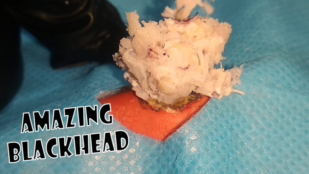 Cyst Material Removal 2 Cyst Material Removal 1