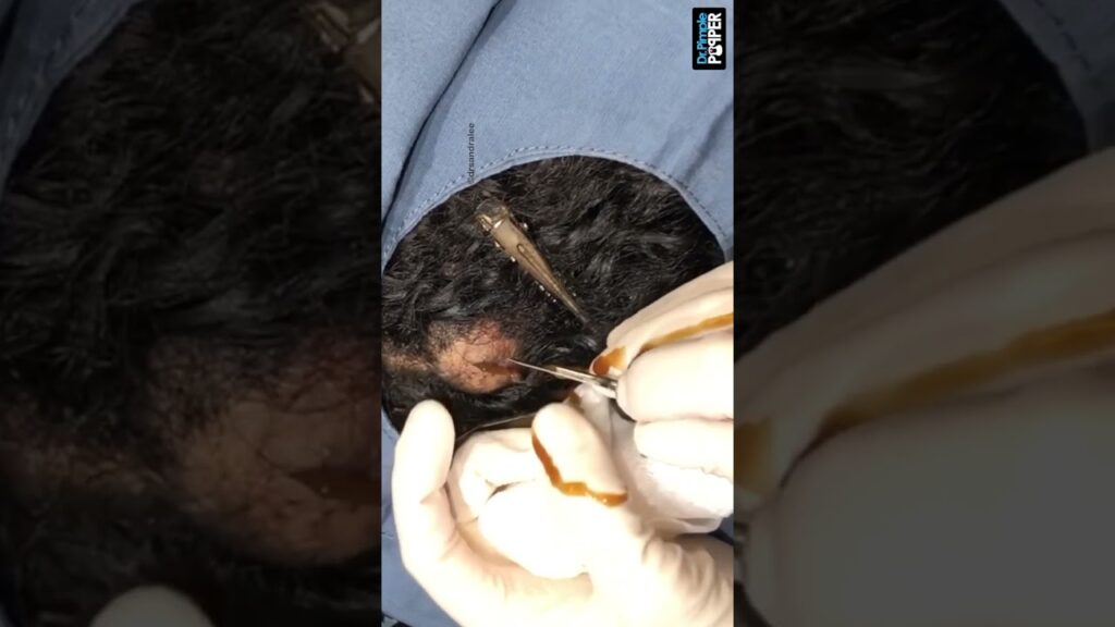 Gravy Cyst 1