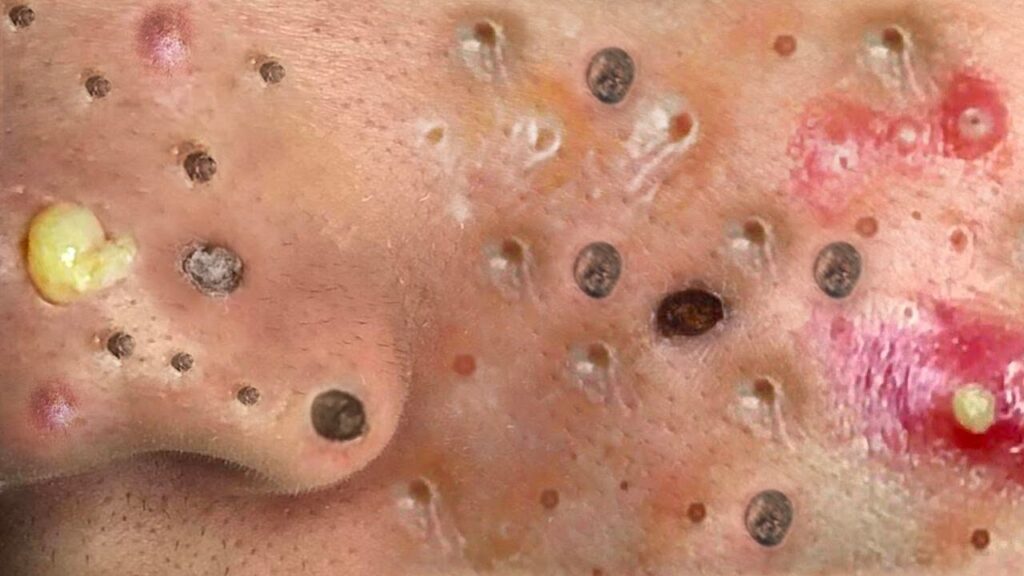 Loan Nguyen Relax with Pimples 1
